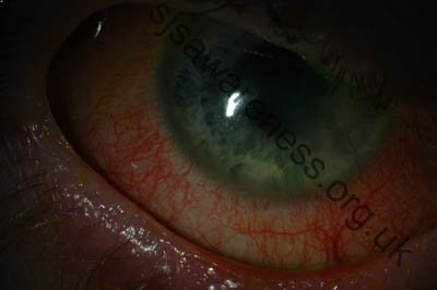 Right Eye - 24 year old male who suffered Toxic Epidermal Necrolysis Syndrome with severe Ocular involvement. Photo was taken 2 years after the initial TEN reaction